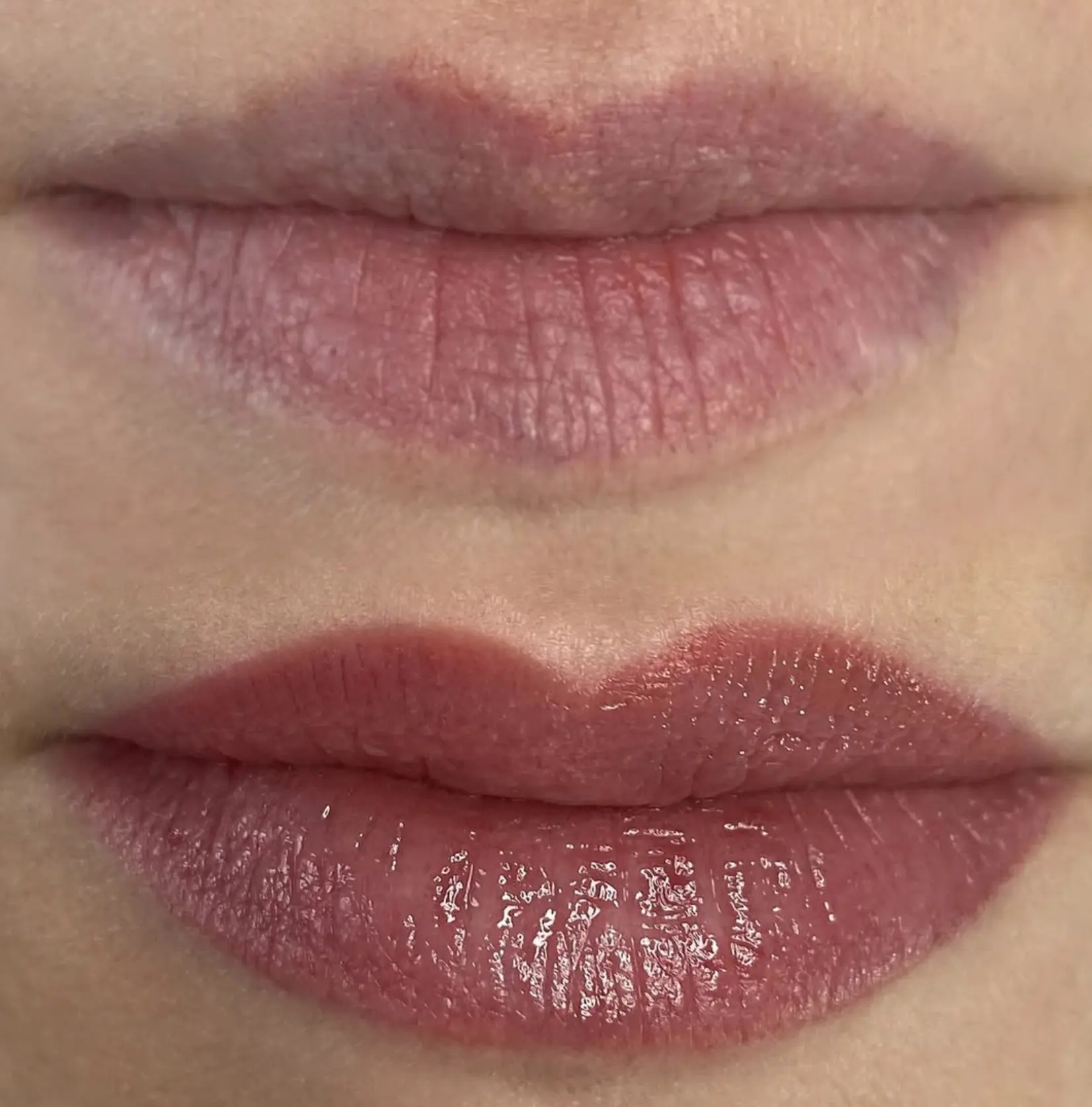 lip neutralization