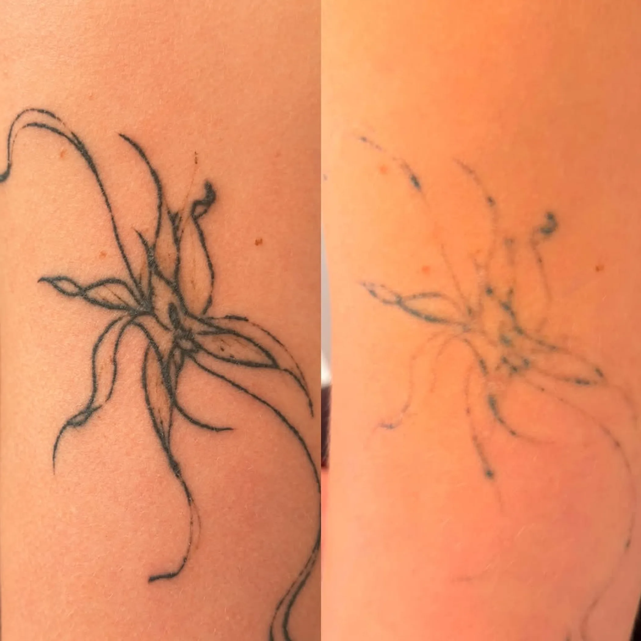 tattoo fading process close-up